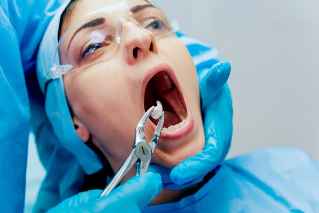 Clínica Dental Sorias -beneficios de la colocación de implantes dentales - Blog - Extracción diente