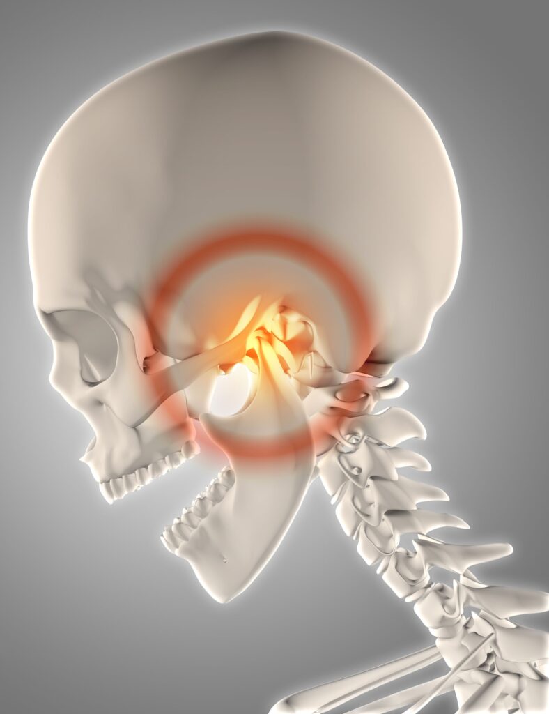 Clínica Dental Sorias - Blog - La posible relación entre el dolor de cabeza y el dolor de muelas - Dolor de cabeza en vista de cráneo