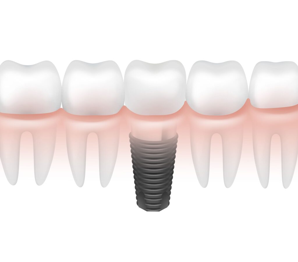 Clínica Dental Sorias - Blog - El reto de la apertura de la línea de incisión - Implante Representado