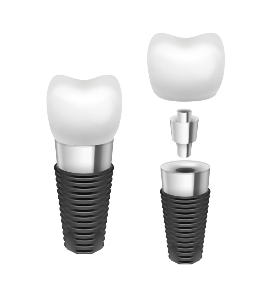 Clínica Dental Sorias - Blog - Implantes dentales: Una guía completa para resolver dudas - Partes de un implante