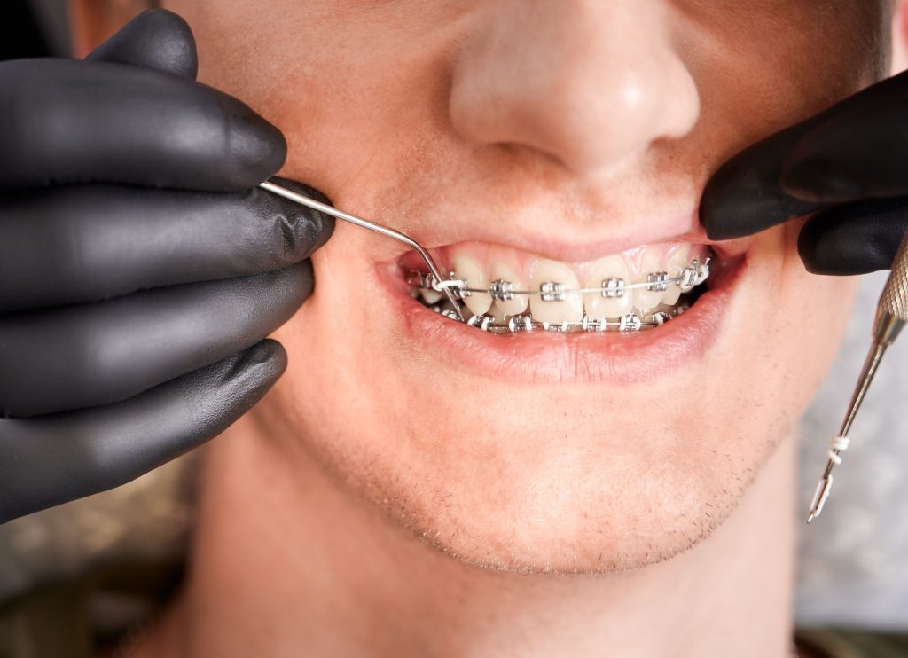 Clínica Dental Sorias - Blog - ortodoncista que coloca bandas de goma en los aparatos dentales de un paciente varón