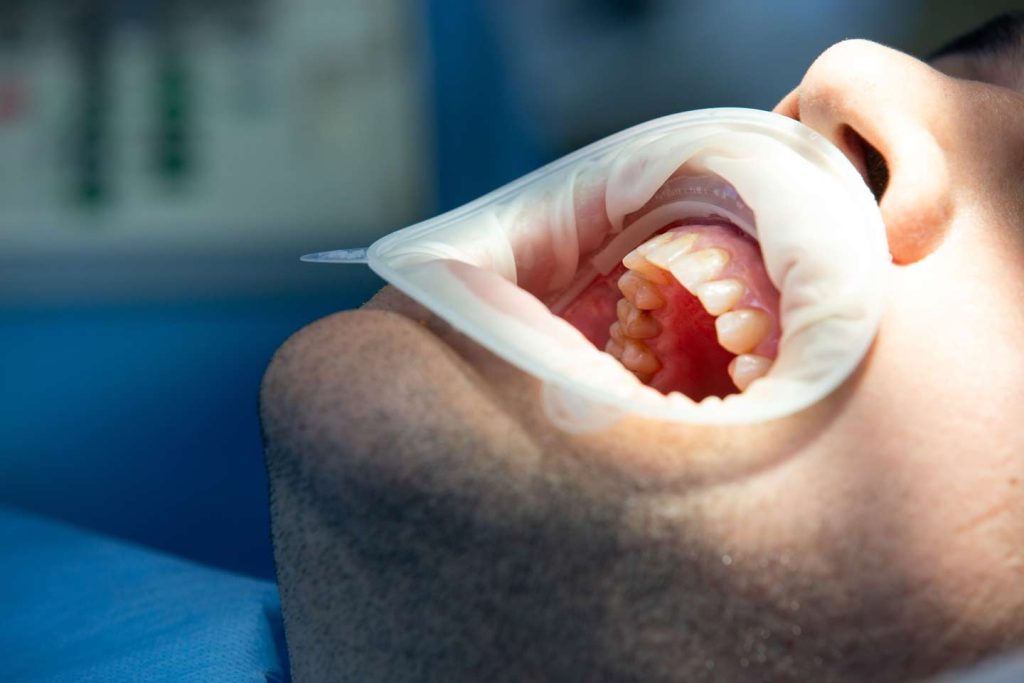 Paciente en el dentista por retracción de encías.