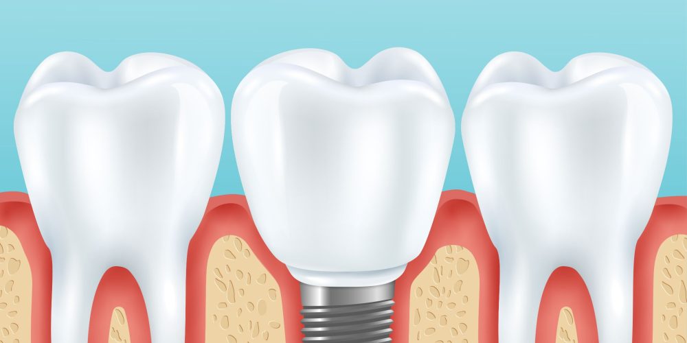 ¿Qué es un implante dental y por qué es tan popular?