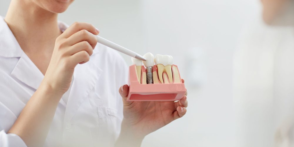 Mantenimiento adecuado de los implantes dentales