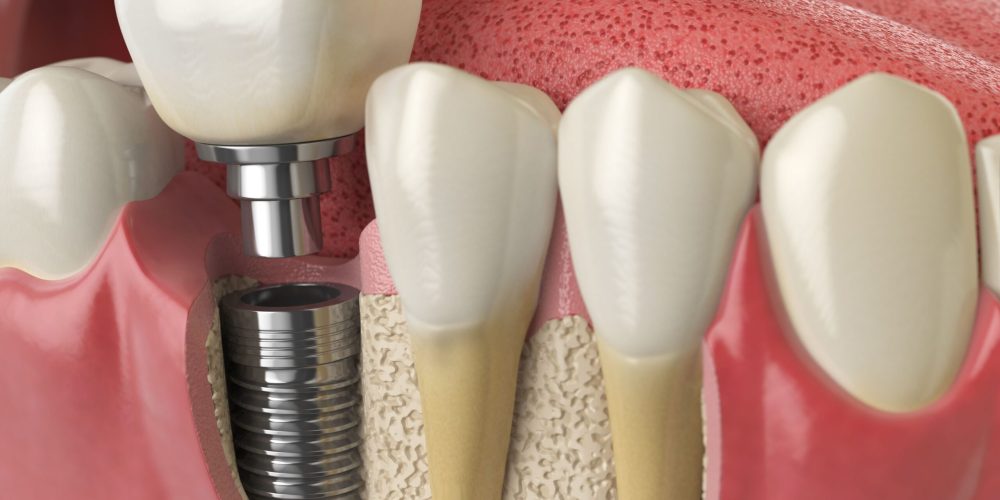 Implantes dentales: Una guía completa para resolver dudas
