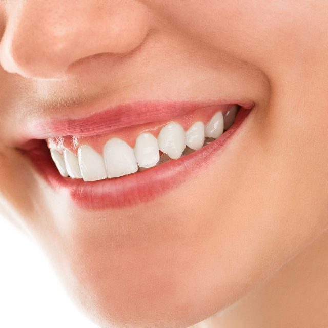 Blanqueamiento dental profesional: ¿Qué es? ¿Cuánto dura?