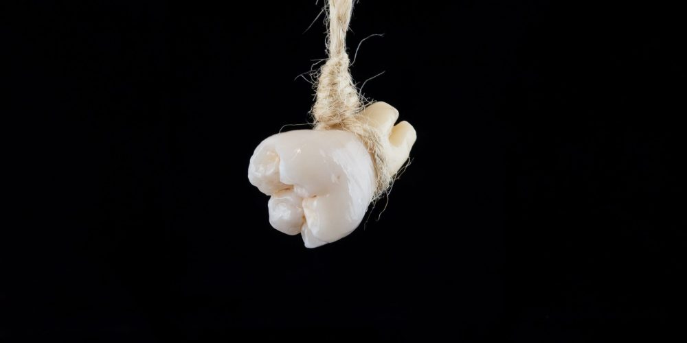 Cuando un diente comprometido es una amenaza y beneficios de la colocación de implantes