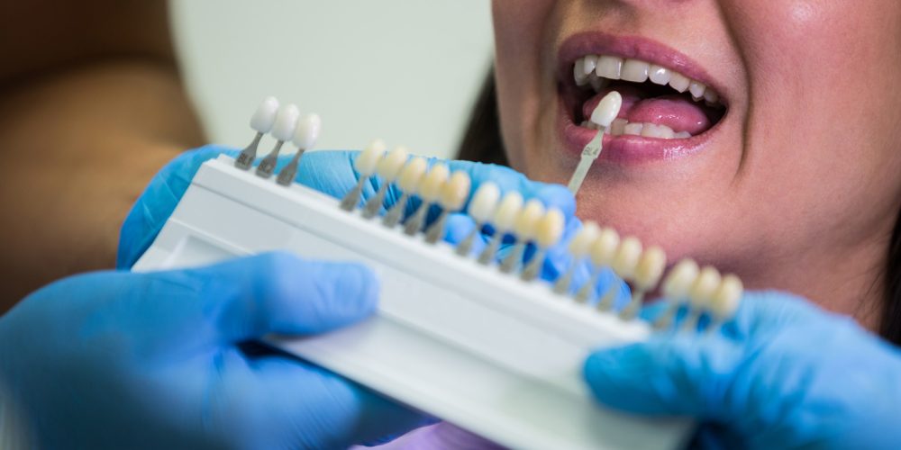 Descubre qué tipos de blanqueamiento dental existen