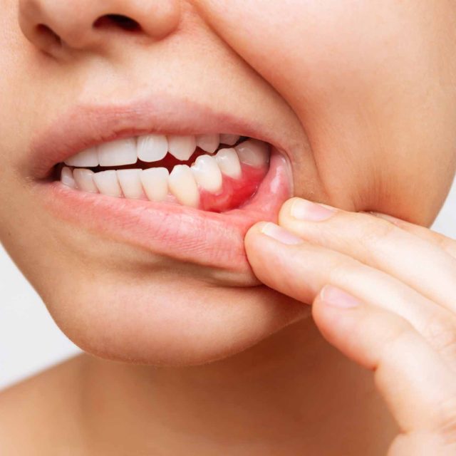 Enfermedad periodontal o piorrea: Una amenaza para tu Salud Bucal