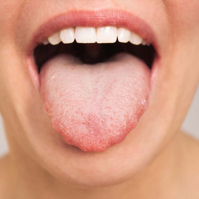 Glositis o lengua inflamada: Síntomas, causas y tratamiento