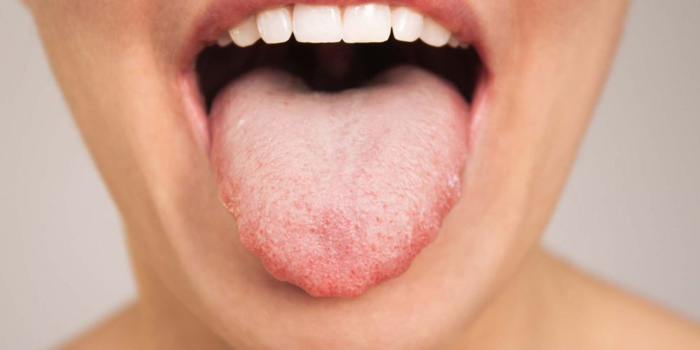 Glositis o lengua inflamada: Síntomas, causas y tratamiento