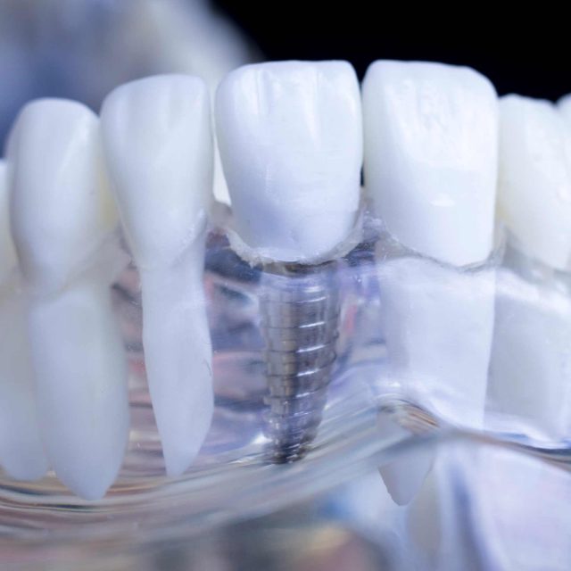 Implantes dentales: la solución definitiva