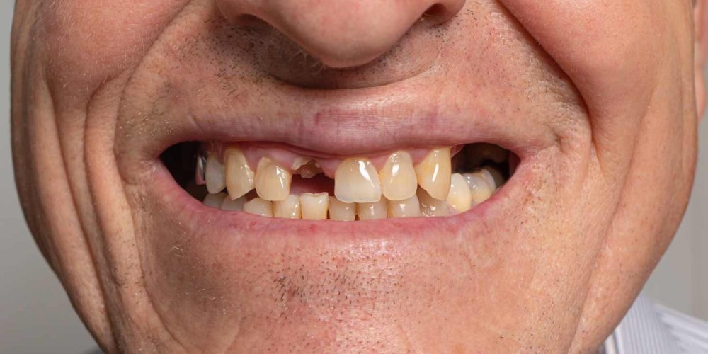 Pérdida de dientes: causas, consecuencias y soluciones