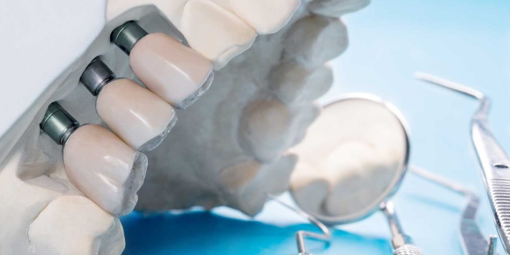 Implantes dentales con regeneración ósea: solución cuando no hay suficiente hueso