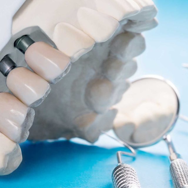 Implantes dentales con regeneración ósea: solución cuando no hay suficiente hueso