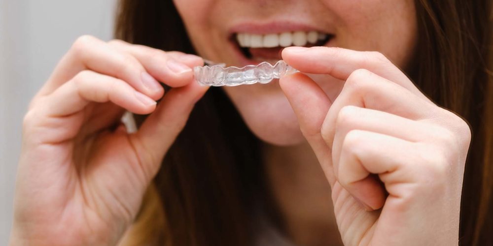 ¿En qué casos no se puede usar Invisalign?