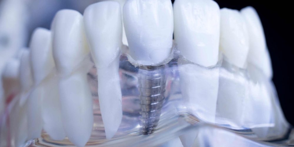 Implantes dentales: la solución definitiva