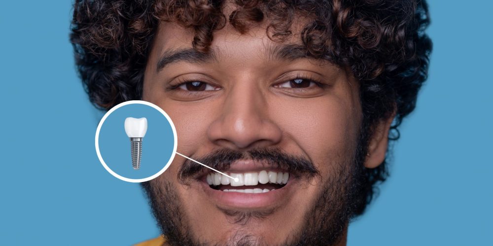 Postoperatorio de implantes dentales: cuidado y mantenimiento