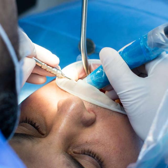Injerto de encía por retracción gingival: Cuándo es necesario y claves del postoperatorio